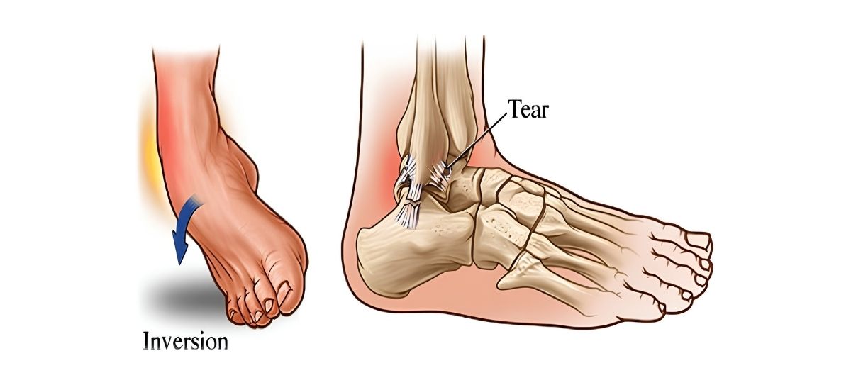 Ankle Inversion Injury